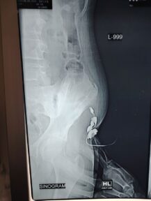 Pediatric-surgery-case3-03 Pediatric-surgery-case3-03