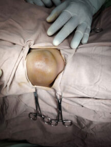 Tumour-Surgery-case6-2 Tumour-Surgery-case6-2