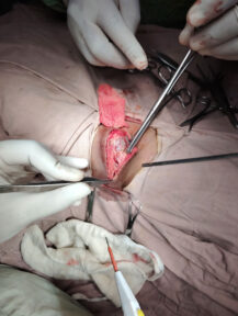 Tumour-Surgery-case6-3 Tumour-Surgery-case6-3