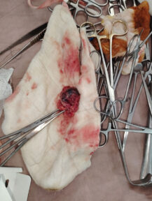 Tumour-Surgery-case6-4 Tumour-Surgery-case6-4